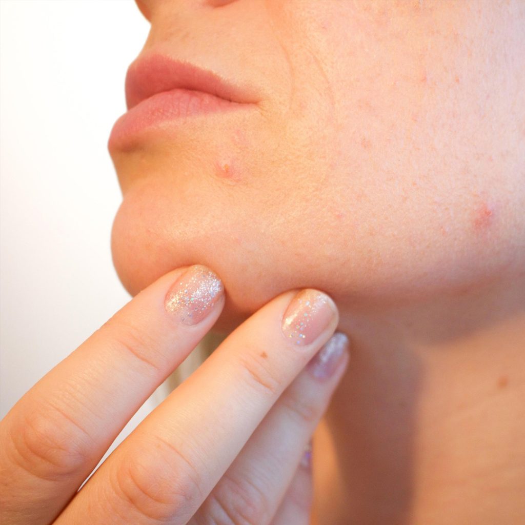 A close-up showing the successful treatment of cystic acne, representing the medical-grade acne solutions at Medinova.